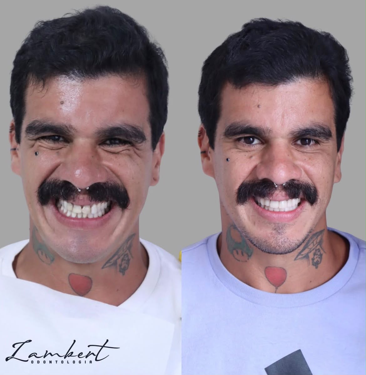 Implante Dentário